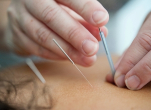 ACUPUNCTURE IS A TECHNIQUE DERIVED FROM CHINESE MEDICINE THAT SEEKS TO REDUCE PHYSICAL AND MENTAL TENSION BY INSERTING SMALL NEEDLES INTO SPECIFIC POINTS OF THE BODY, WHICH ARE CALLED MERIDIANS.